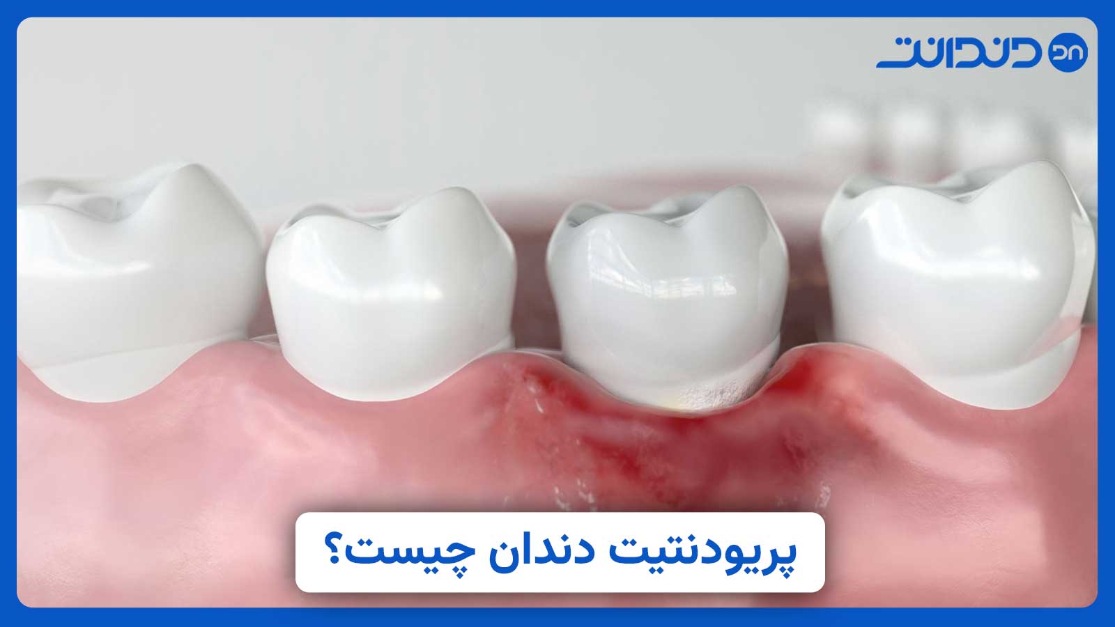 پریودنتیت چیست؟ علل، علائم و روش‌های درمان