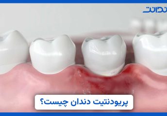 عکس التهاب لثه در زیر دندان