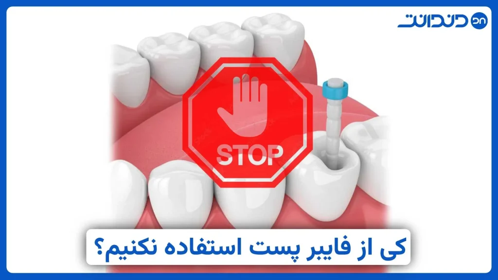 کی از فایبرپست استفاده نکنیم؟