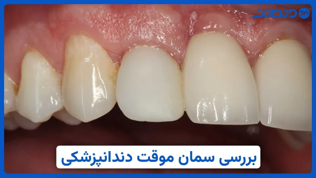 عکس دندان که با کمک سمان موقت دندانپزشکی ترمیم شده است.