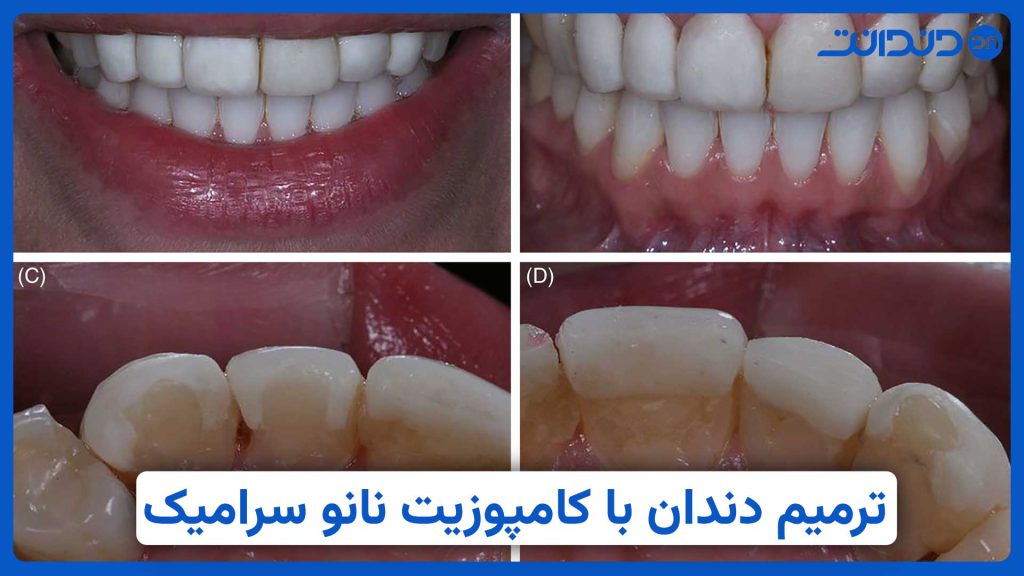 عکس از دندان که با کمک کامپوزیت نانوسرامیک ترمیم میشود