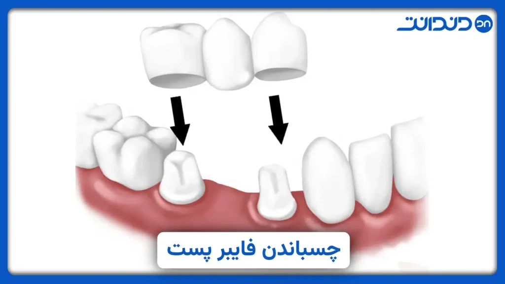 عکس از نحوه گذاشتن فایبر پست دندان