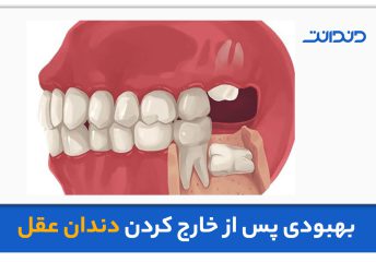 عکس نزدیک از دندان عقل و سایر دندان های کناری