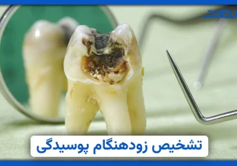 عکس نزذیک از دندان پوسیده