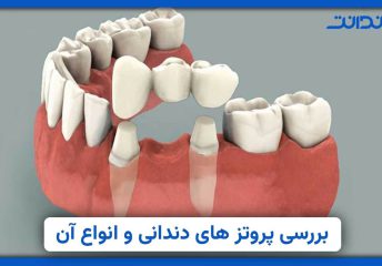 عکس نمایس نزدیکاز پرئتز های دندانی