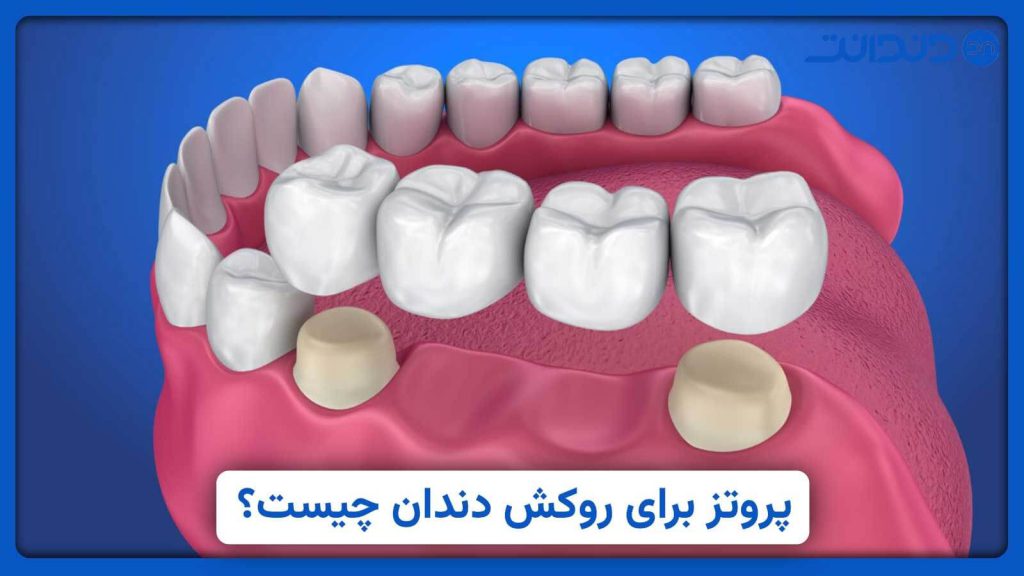 عکس نزدیک از پروتز کردن دندان و دهان