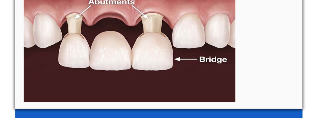 عکس از تکنیک بریج دندانپزشکی