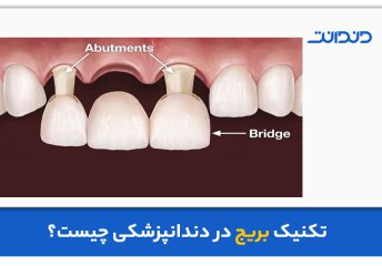 عکس از تکنیک بریج دندانپزشکی