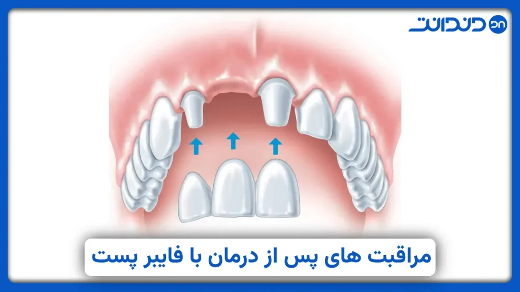 عکس از نحوه گذاشتن فایبرپست در دهان