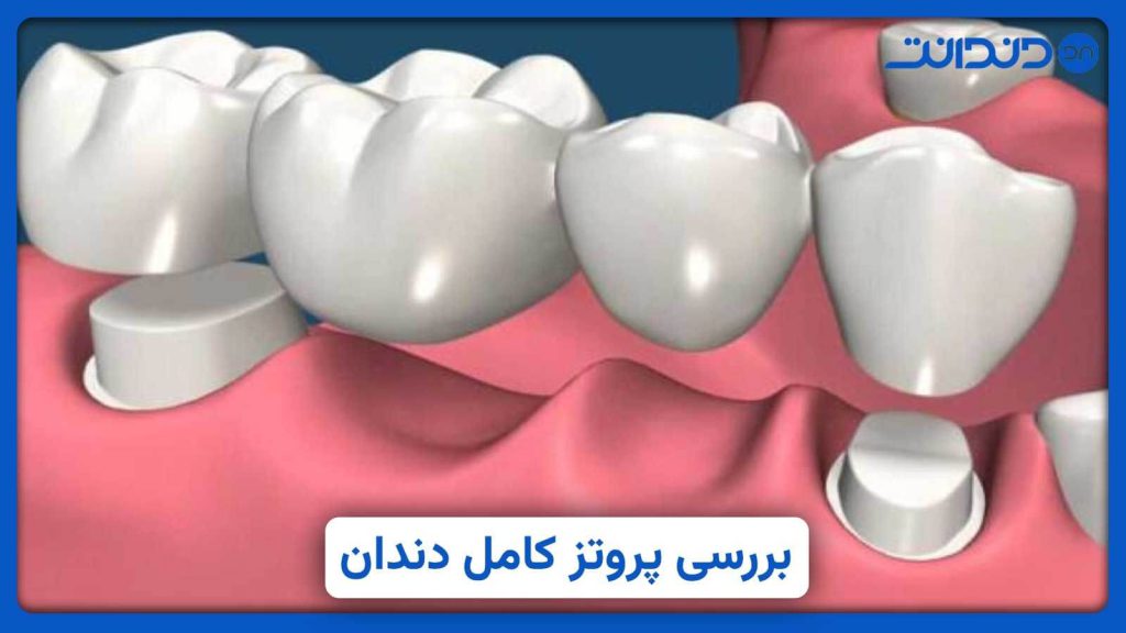 عکس نزدیک از پروتزهای دندانی