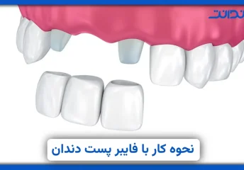 عکس از دندان و فایبرپست