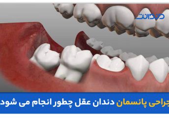 عکس سه بعدی از دندان عقل و فشار آوردن آن به دندان کناری