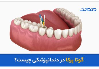 عکس سه بعدی از دهان و دندان و گوتا پرکا بر روی یکی از دندان ها