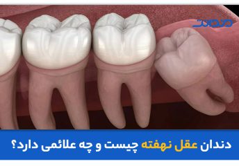 عکس نزدیک از دندان عقل نهفته