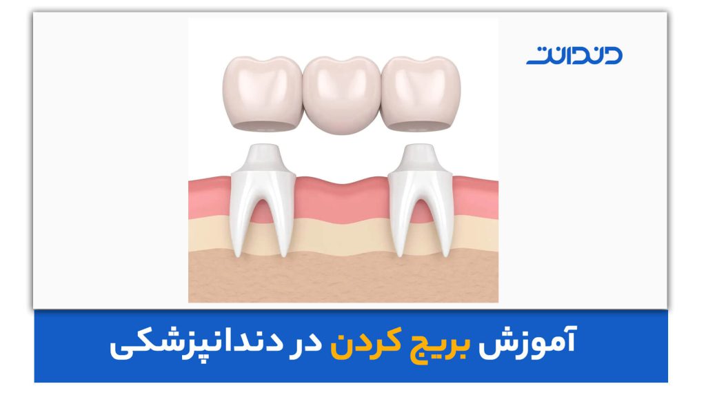 عکس از نحوه بریج گذاشتن دندان