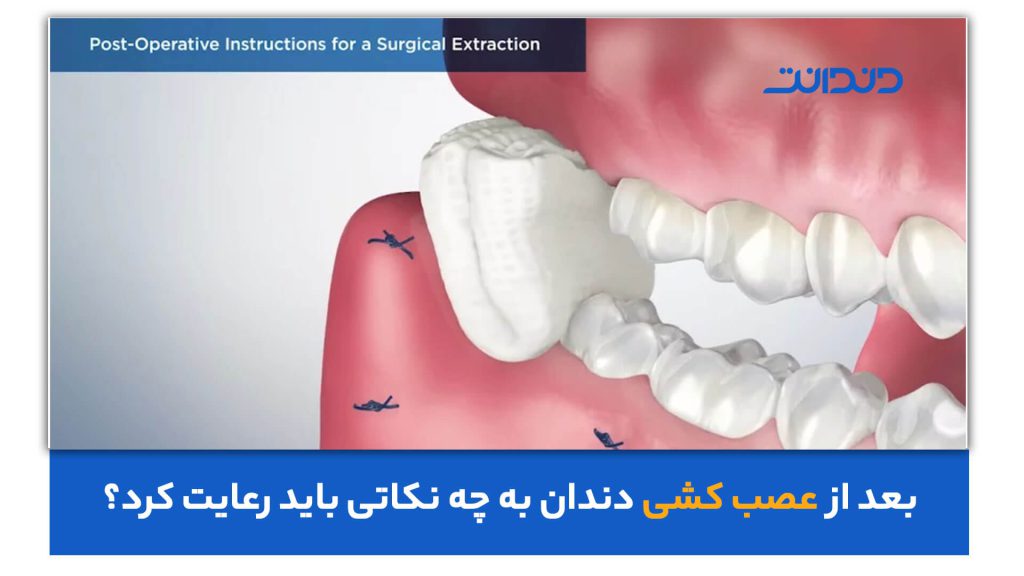 عکس نزیک از دندان پانسمان شده