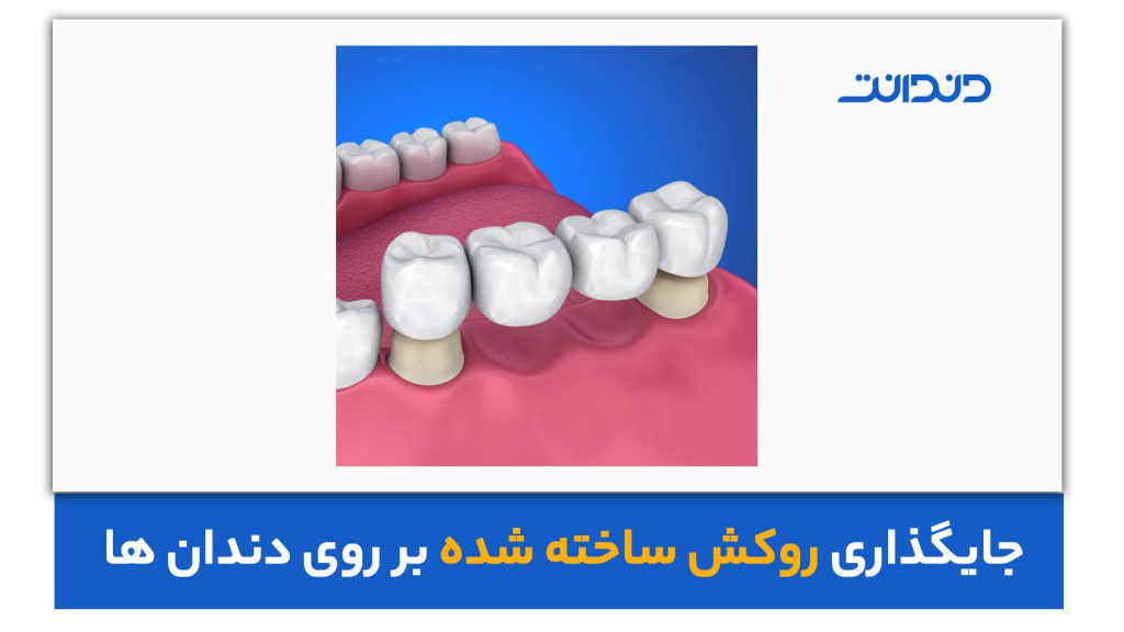 عکس از روکش گذاشتن بر روی دندان از طریق بریج