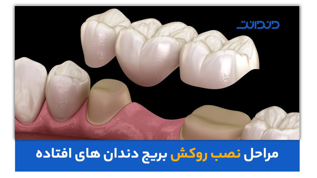 عکس نزدیک از بریج دندانپزشکی