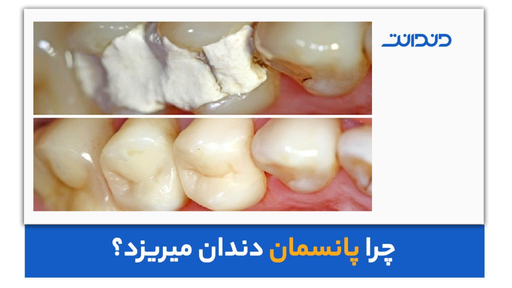 عکس از دندان پانسمان شده و پانسمان نشده در کنار هم