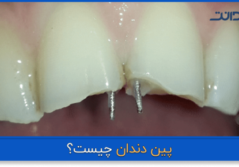عکس نزدیک از پین دندان