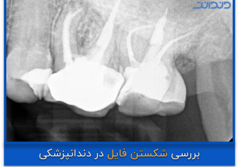 عکس رادیو گرافی از شکسته شدن فایل دندان در دندان