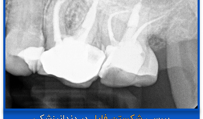 عکس رادیو گرافی از شکسته شدن فایل دندان در دندان