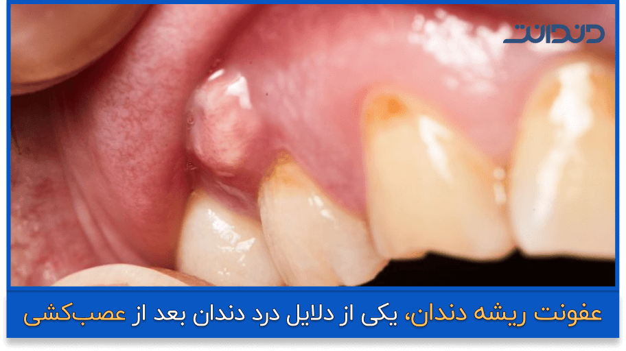 علت درد دندان پانسمان شده