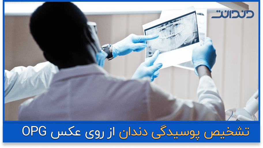 تشخیص پوسیدگی دندان از روی عکس OPG