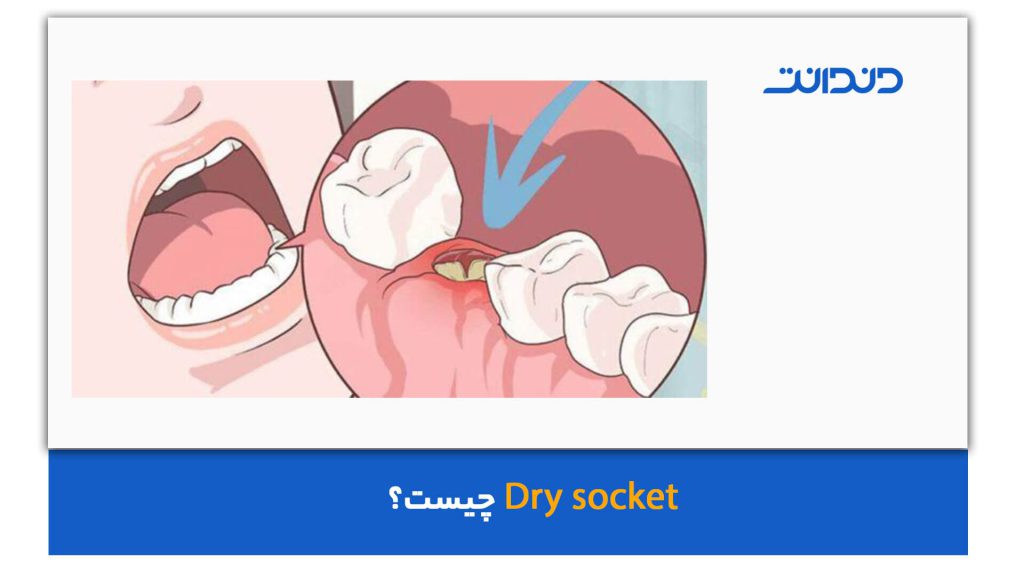 عکس از Dry Socket