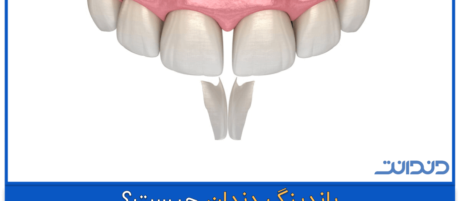 باندینگ دندان چیست؟