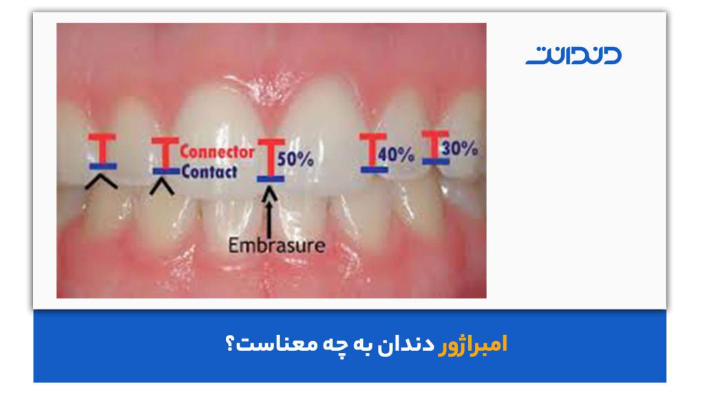 بررسی سطح امبراژور دندان