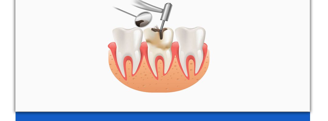 روت کانال دندانپزشکی چیست؟