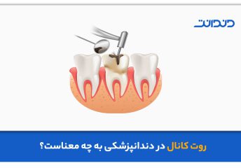 روت کانال دندانپزشکی چیست؟