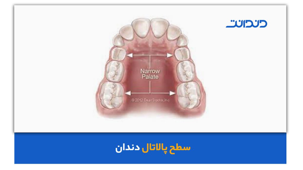 عکس سطج پالاتال دندان