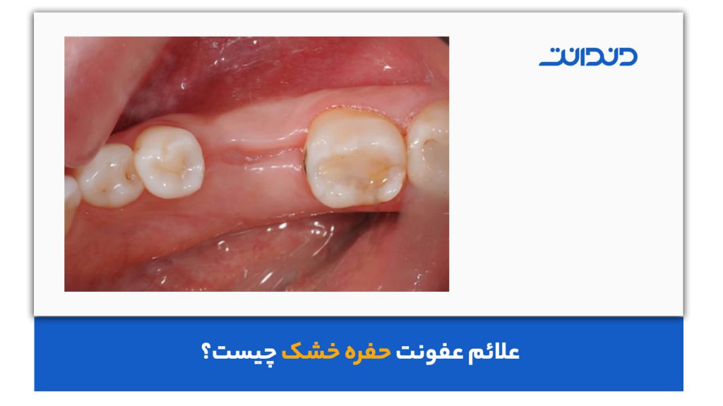 علائم حفره خشک دندان