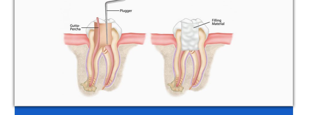 فرق روت کانال و عصب کشی در دندانپزشکی
