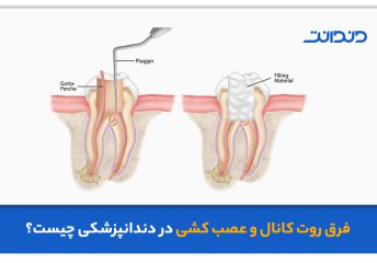 فرق روت کانال و عصب کشی در دندانپزشکی