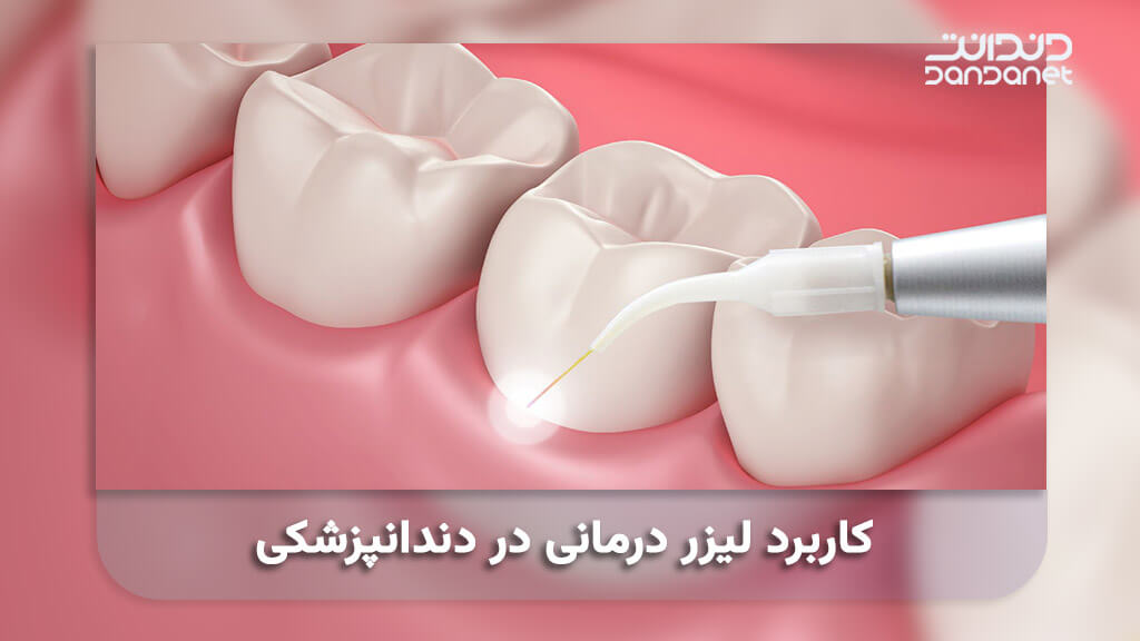 کاربرد لیزر درمانی در دندانپزشکی