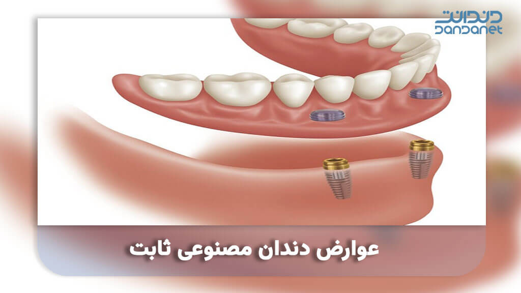 عوارض دندان مصنوعی ثابت