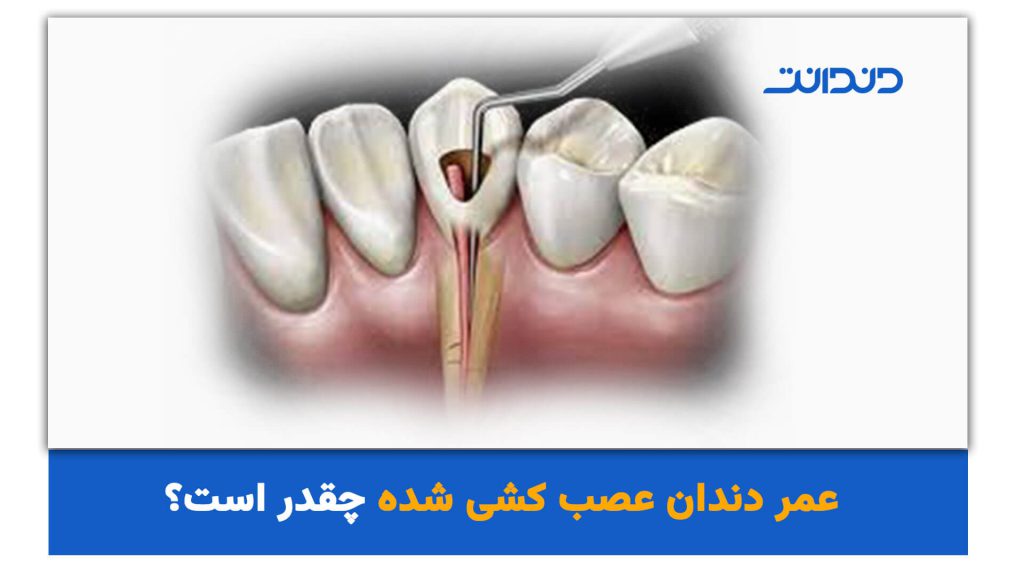 عمر دندان عصب کشی شده چقدر است؟