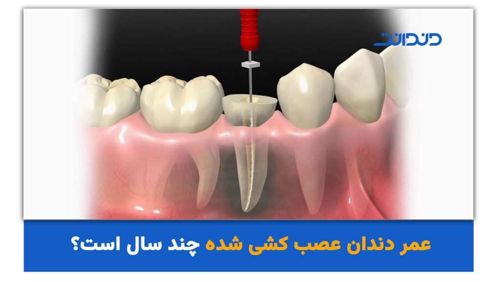 عمر دندان عصب کشی شده چند سال است؟