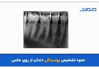 نحوه تشخیص پوسیدگی دندان از روی عکس
