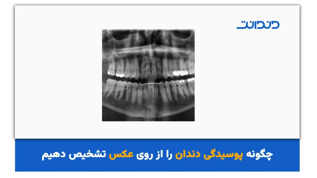 تشخیص پوسیدگی دندان از روی عکس