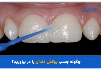 چگونه چسب روکش دندان را بیاوریم؟