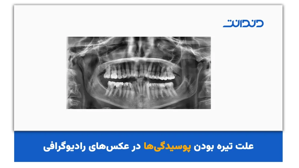 علت تیره بودن پوسیدگی‌ها‌ در عکس‌های رادیوگرافی