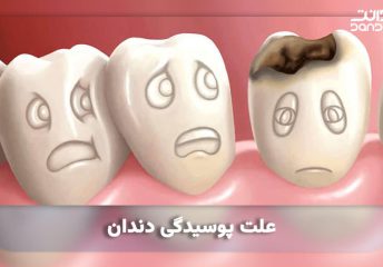 علت پوسیدگی دندان چیست