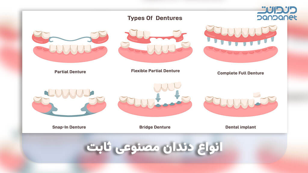 انواع دندان مصنوعی ثابت 