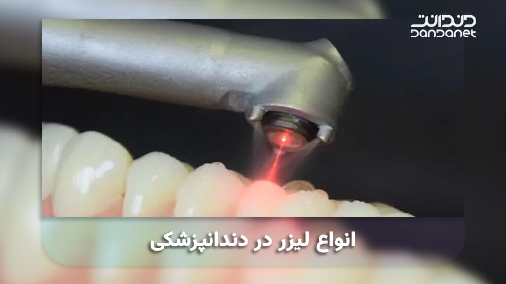 انواع لیزر درمانی در دندانپزشکی