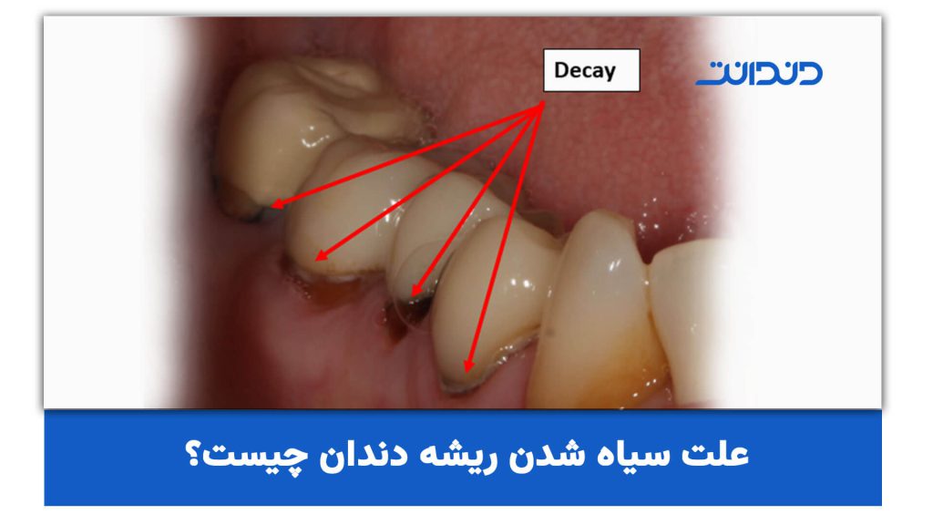 علت سیاه شدن ریشه دندان چیست؟