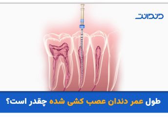 طول عمر دندان عصب کشی شده